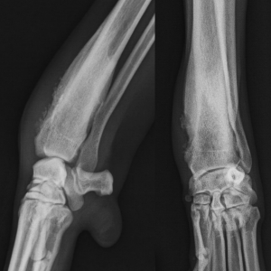 Antebrachial Fractures: Part 1*