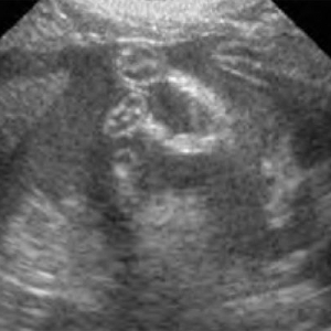Management of canine primary immune-mediated thrombocytopenia (ITP)*