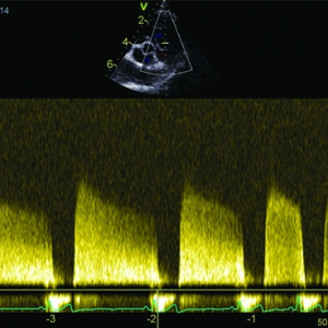 Pulmonary hypertension; demystifying the disorder