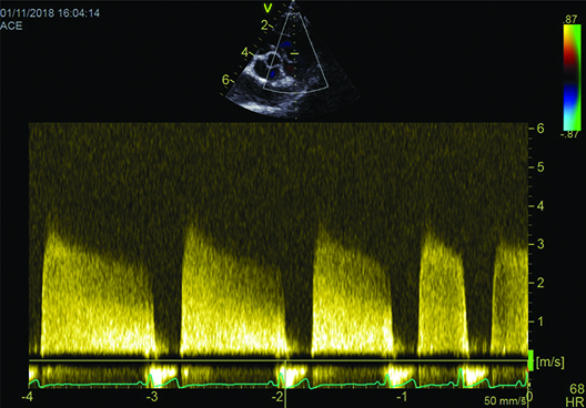Pulmonary hypertension; demystifying the disorder