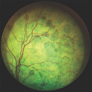 Approach to the Blind Patient*