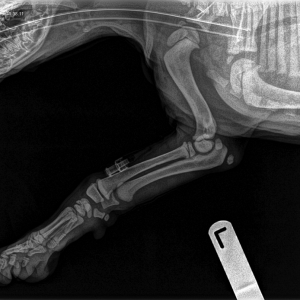 Antebrachial Fractures: Part 2*