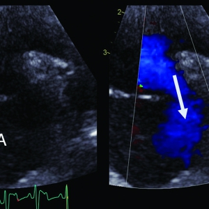 Cyanotic heart diseases in dogs: when erythrocytosis becomes problematic