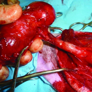 Surgical management of thyroid and parathyroid tumours