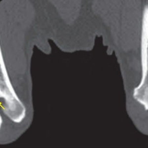 Canine humeral intracondylar fissure: a review*